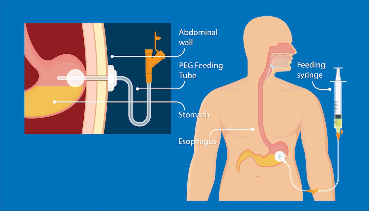 binod maharjan add Feeding Tube Porn photo